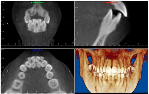 Cbct Scan For Orthodontics Oral Radiology Toronto