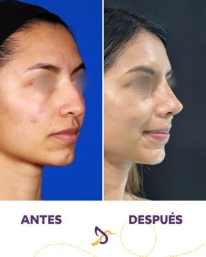 Rinoplastia Dra Lina Franco Cirujana Pl Stica Y Reconstructiva