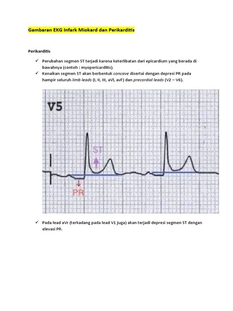 Gambaran Ekg Infark Miokard Dan Perikarditis Pdf