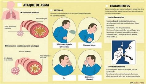 Cómo evitas las crisis de asma AGENCIAFE