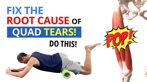 4 Exercises To Fix Quadriceps Strains Tendonitis And Tears For Good