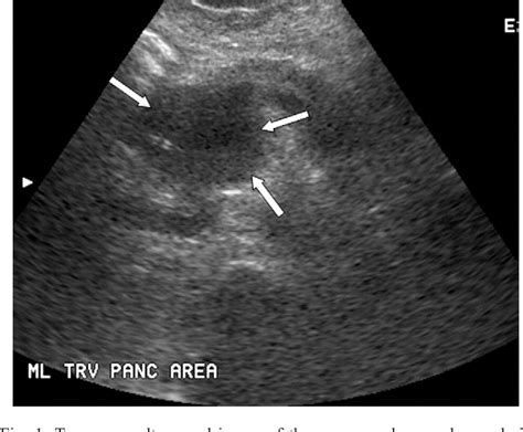 Figure 1 From Extramedullary Plasmacytoma Of The Pancreas And Jejunum