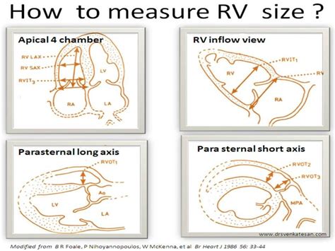 What Is The Normal Rv Size How To Measure It By Echocardiography Drsvenkatesan Md