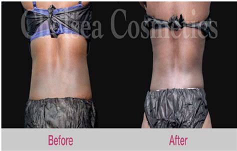 Consider Liposuction For Perfect Contouring | Ublabs.org