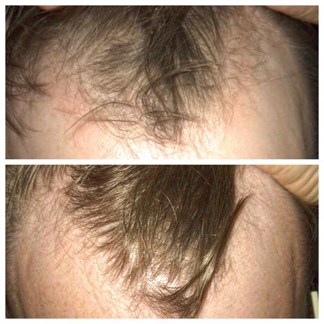 6 Months Hairline Update On Finasteride R Tressless