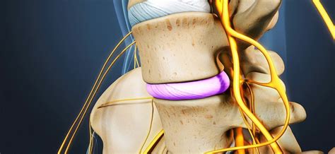 Treating Lumbar Disk Herniation By Oxygen Ozone Therapy Ozone Clinic