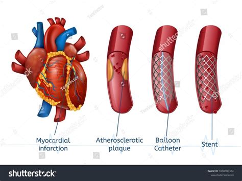 PVC PTCA Coronary Stent For Hospital At Rs 15000 In New Delhi ID