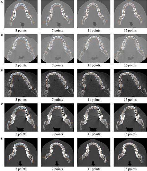 Frontiers Reconstruction of Panoramic Dental Images Through Bézier