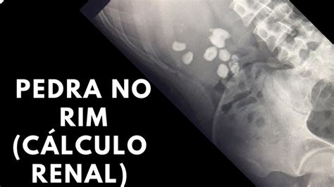 Pedra no rim cálculo renal Radiologia Prática YouTube