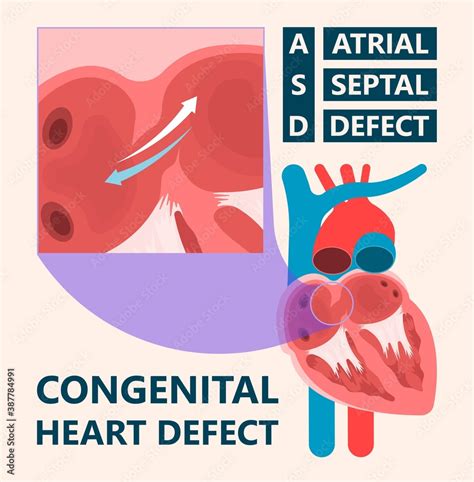 Cath Lab Atrial Septal Defect Tetralogy Of Fallot Patent Foramen Ovale