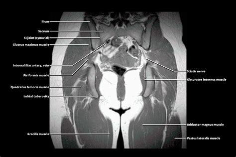 MRI Pelvis Muscle Anatomy