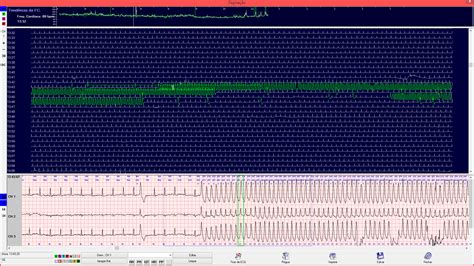 Dms Brasil Analisador De Holter Cardioscan