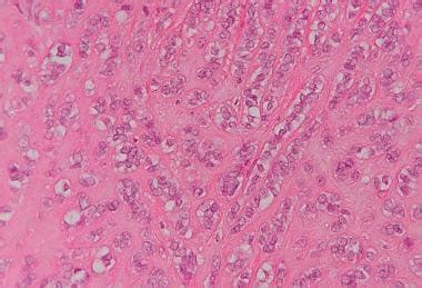 Pathology Of Sex Cord Stromal Testis Tumor Definition Epidemiology