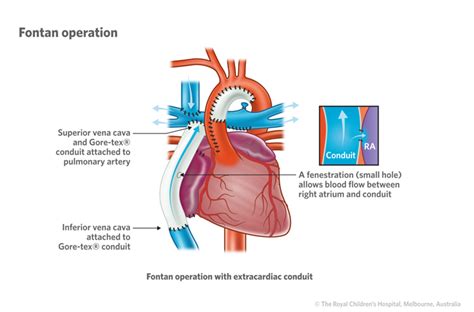 Cardiology : Hypoplastic Left Heart Syndrome HD