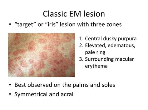 Ppt Erythema Multiforme Powerpoint Presentation Free Download Id6770484