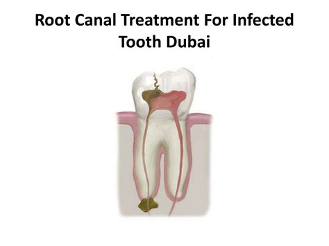 Ppt Root Canal Treatment For Infected Tooth Dubai Powerpoint