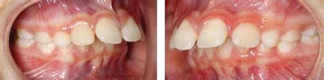 Treatment For Class Ii Malocclusion Pocket Dentistry