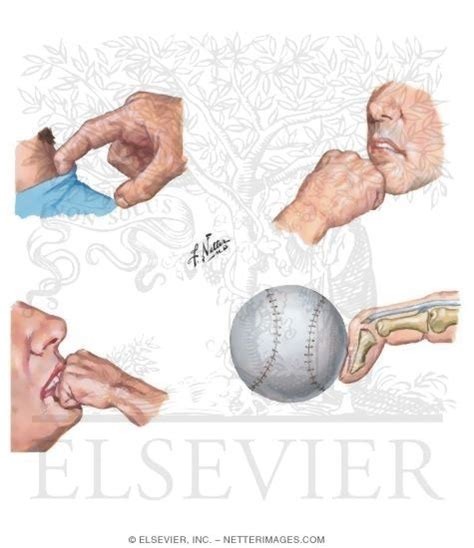 Jersey Finger Boxer Fracture Fight Bite Mallet Finger