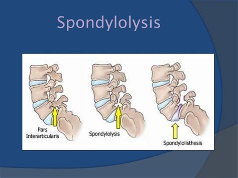 Ppt Spondylolysis Powerpoint Presentation Free Download Id1939741