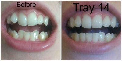 Crowded Bottom Teeth Invisalign