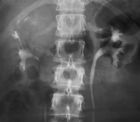 Intravenous Urography Technique And Interpretation Radiographics