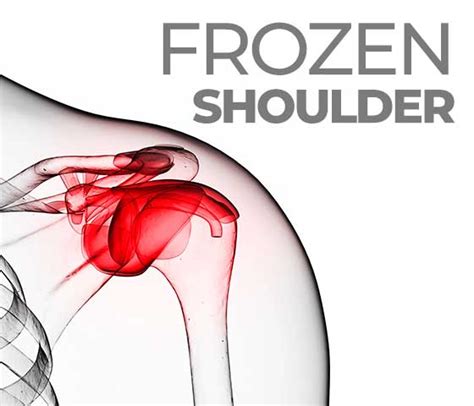 Frozen Shoulder