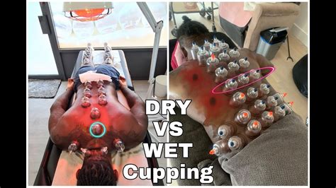 Dry Cupping And Wet Cupping My Experience Youtube