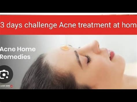 Days Challenge Acne Treatment At Home Acne Free Face In Just Days