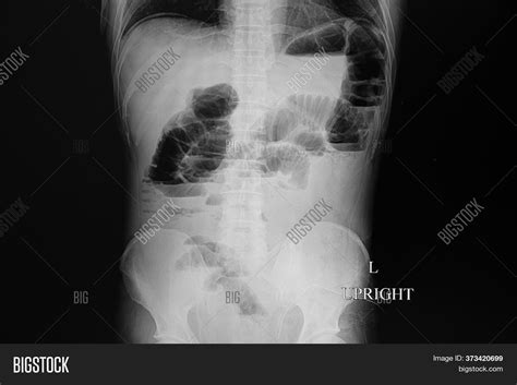 Abdominal Supine X Ray Image And Photo Free Trial Bigstock