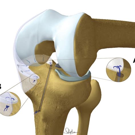 Medial Meniscal Allograft Suturing To The Capsule With All Inside