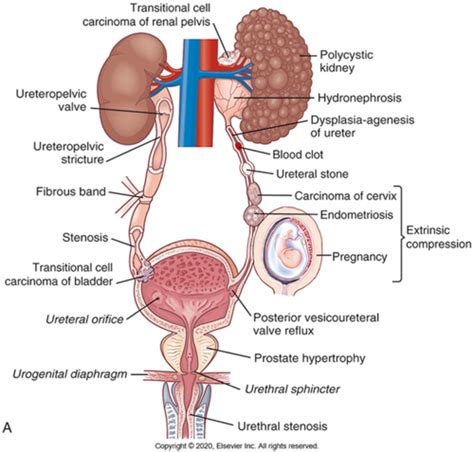 Patho Ch Alterations Of Renal And Urinary Tract Function Flashcards