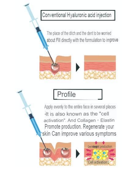 Profhilo Injection (Improve Skin Elasticity and Hydration) | Trambellir