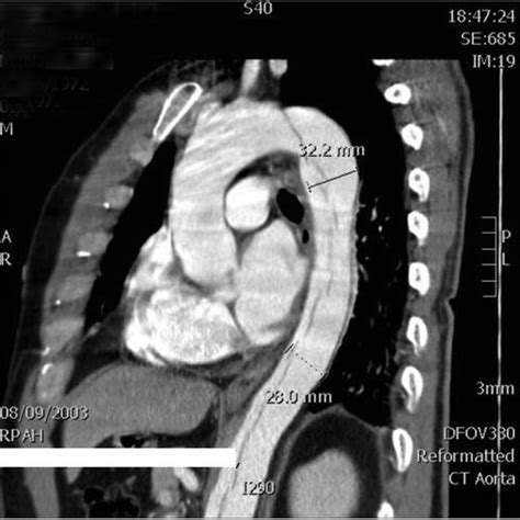 Aortic Dissection Ct Scan