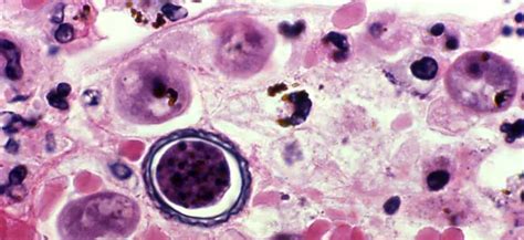 Acanthamoeba Granulomatous Amebic Encephalitis Gae Keratitis Acanthamoeba Parasites Cdc