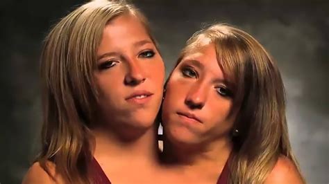 Unraveling The Extraordinary Lives Of Conjoined Twins