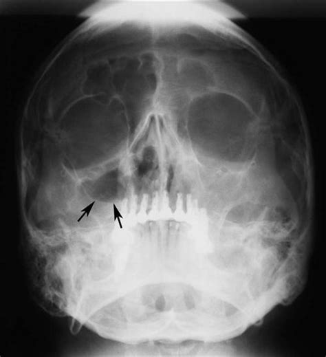 26. Paranasal Sinus Diseases | Pocket Dentistry