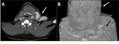 Figure 2 From Unilateral Proptosis Exophthalmos Caused By Axillary