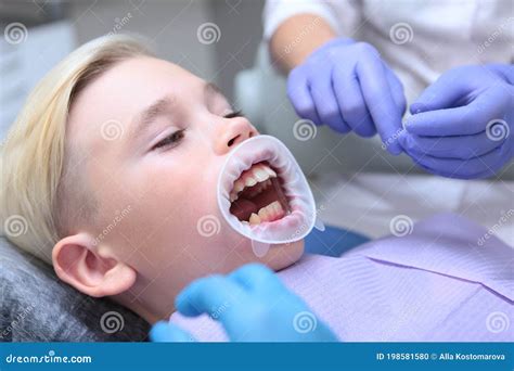 A Dental Retractor In A Little Boy`s Mouth Comfort For Patients