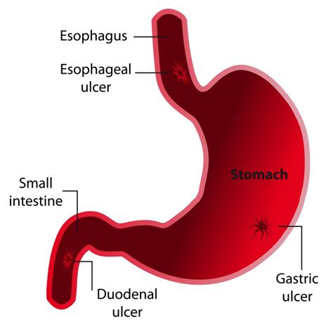 What Are the Best Tips for a Gastric Ulcer Diet?