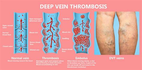 What Is Deep Vein Thrombosis Dvt Hill Vascular And Vein Center