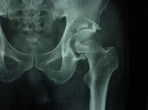 Figure From Treatment Of Postoperative Sciatic Nerve Palsy After