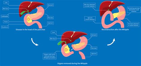 Whipples — Hepatobiliary And Upper Gastrointestinal Surgery