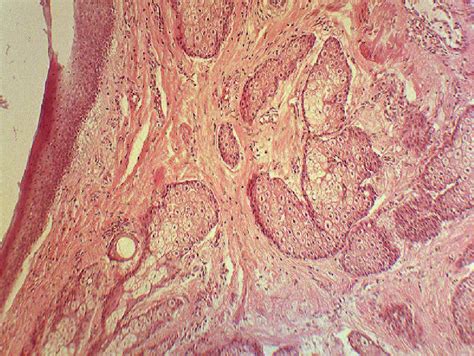 Mature Cystic Teratoma Of Ovary Ectodermal Structure Of Skin And