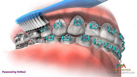 Brushing And Flossing While In Braces Orthodontic Instruction Youtube