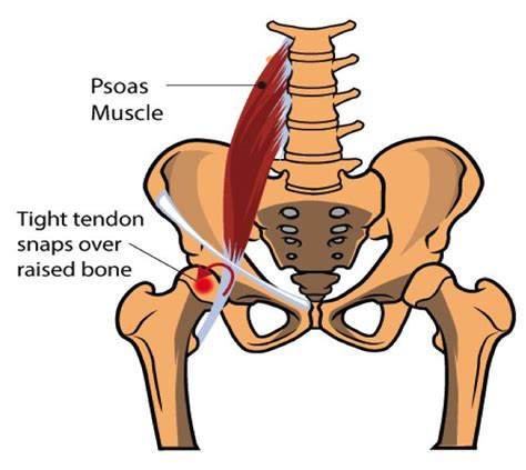 Condition Of The Month Snapping Hip Learn More Gallery