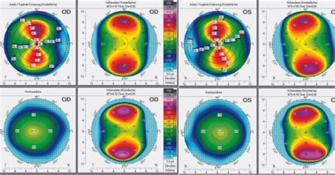 Crstg Europe Edition Extreme Astigmatism In A Pre Presbyopic Patient