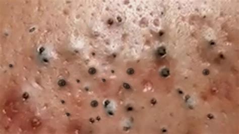 Big Pimple Popping 2023 Removal Blackhead And Whitehead 2023 Youtube