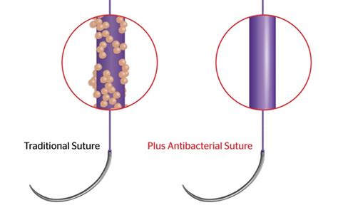 Plus Antibacterial Sutures Ethicon