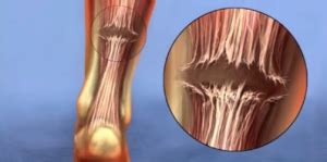 Diagnosis And Treatment For An Achilles Tendon Rupture Foot Houston