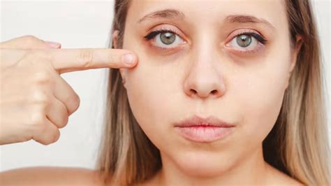 Under Eye Bags Home Remedies To Get Rid Of It Onlymyhealth